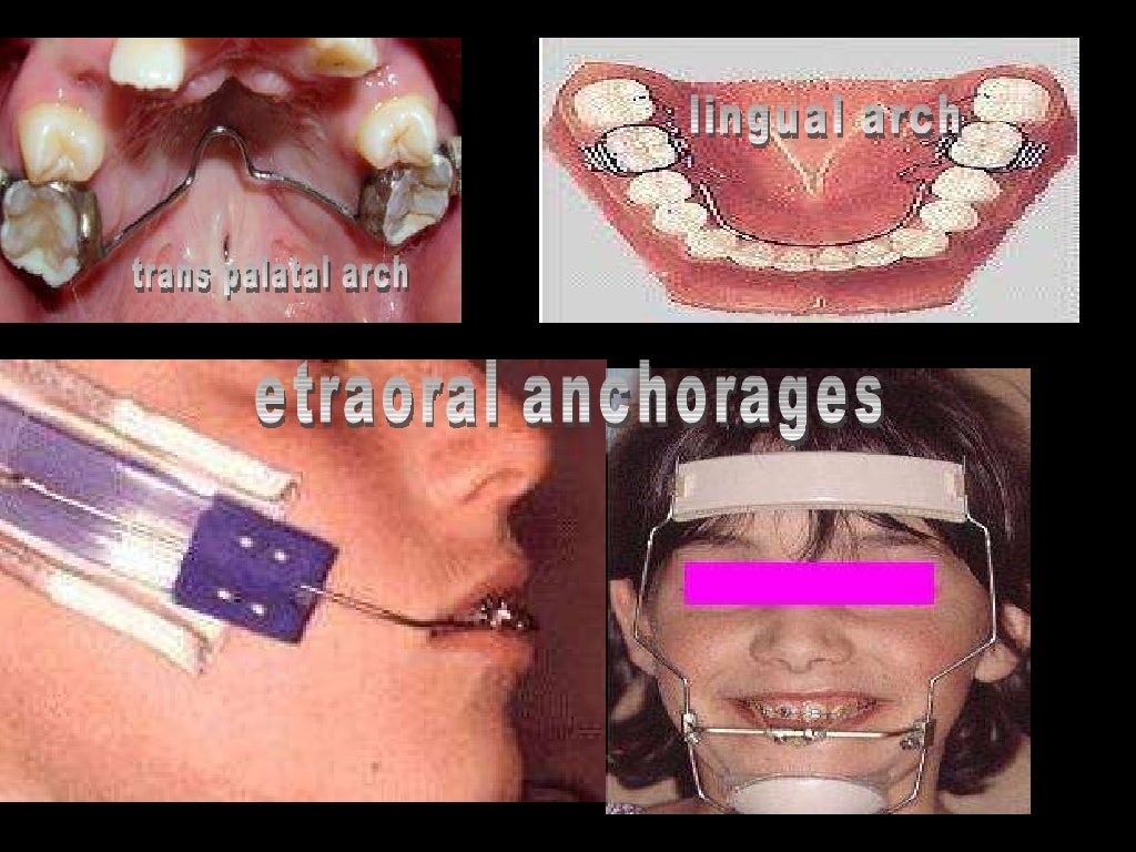 anchorage in orthodontics
