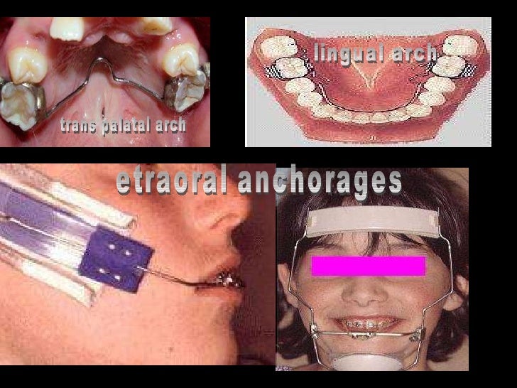 anchorage in orthodontics