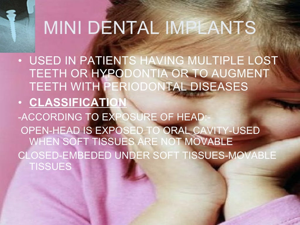 anchorage in orthodontics