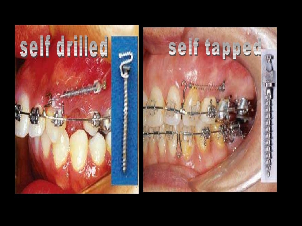 anchorage in orthodontics