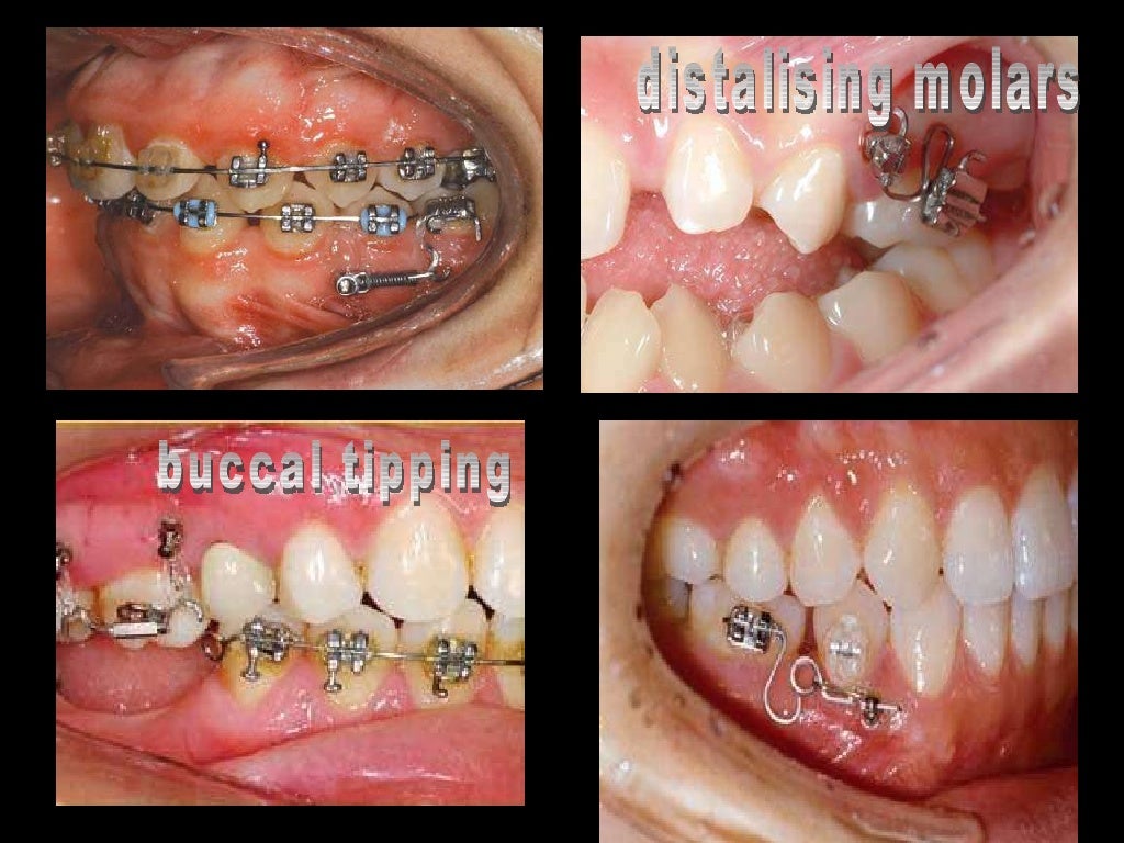 anchorage in orthodontics