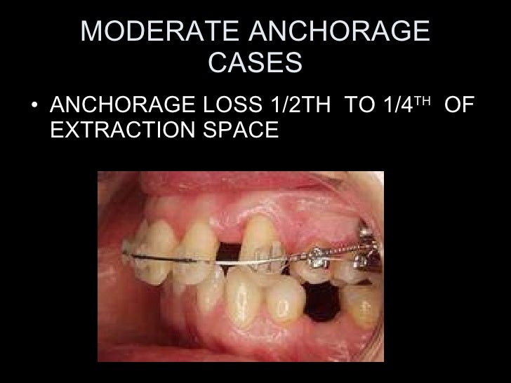 anchorage in orthodontics
