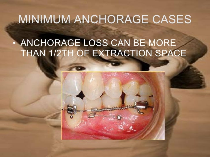 anchorage in orthodontics