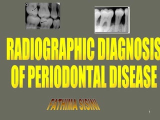 RADIOGRAPHIC DIAGNOSIS  OF PERIODONTAL DISEASE FATHIMA SISINI 