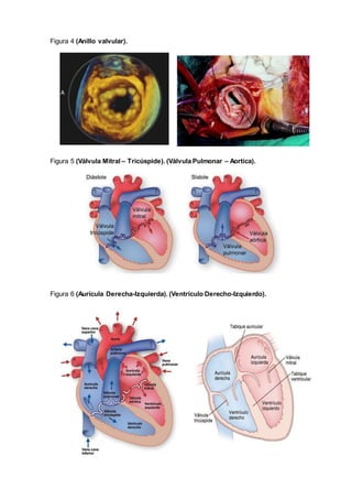 Figura 4 (Anillo valvular).
Figura 5 (Válvula Mitral – Tricúspide). (Válvula Pulmonar – Aortica).
Figura 6 (Aurícula Derecha-Izquierda). (Ventrículo Derecho-Izquierdo).
 