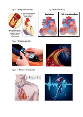 Figura 7 (Bloqueo Cardiaco). Figura8 (SoploCardiaco).
Figura 9 (Presión Arterial).
Figura 10 (Frecuencia cardiaca).
 