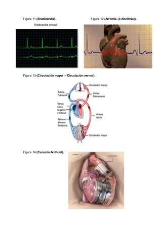 Figura 11 (Bradicardia). Figura 12 (Arritmia (o disritmia)).
Figura 13 (Circulación mayor – Circulación menor).
Figura 14 (Corazón Artificial).
 