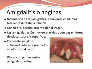 Amigdalitis o anginas
● Inflamación de las amígdalas: a cualquier edad, más
frecuente durante la infancia.
● Con fiebre, decaimiento y dolor al tragar.
● Las amígdalas están muy enrojecidas y con pus en forma
de placas sobre la superficie.
● Frecuente ganglios
submandibulares agrandados
y dolorosos al tacto.
Placas con pus en ambas
amígdalas palatina
 