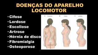 • Cifose
• Lordose
• Escoliose
• Artrose
• Hérnia de disco
• Fibromialgia
• Osteoporose
 