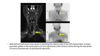 • Well defined soft tissue mass lesion is abutting the inferior pole of the left thyroid lobe. It shows
punctate uptake in the early phase (15 min registration) that remains active during the late phase
(2 hours) characteristic of parathyroid adenoma.
 