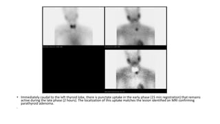 • Immediately caudal to the left thyroid lobe, there is punctate uptake in the early phase (15 min registration) that remains
active during the late phase (2 hours). The localization of this uptake matches the lesion identified on MRI confirming
parathyroid adenoma.
•
 