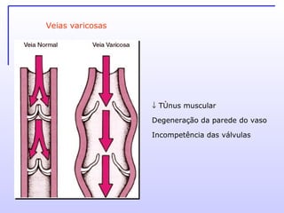Veias varicosas    Tônus muscular  Degeneração da parede do vaso Incompetência das válvulas 