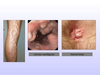 Varizes esofágicas Hemorróida 