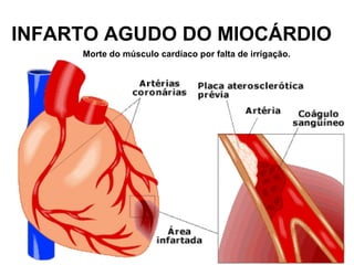 INFARTO AGUDO DO MIOCÁRDIO
     Morte do músculo cardíaco por falta de irrigação.
 