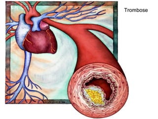 Trombose
 