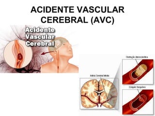 ACIDENTE VASCULAR
  CEREBRAL (AVC)
 