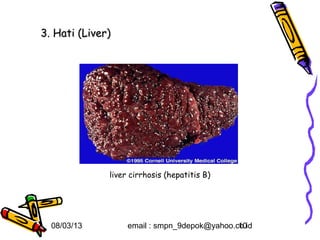3. Hati (Liver)




              liver cirrhosis (hepatitis B)




  08/03/13         email : smpn_9depok@yahoo.co.id
                                              10
 