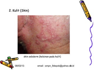 2. Kulit (Skin)




           skin-sebderm (kelainan pada kulit)


    08/03/13           email : smpn_9depok@yahoo.co.id
                                                  9
 
