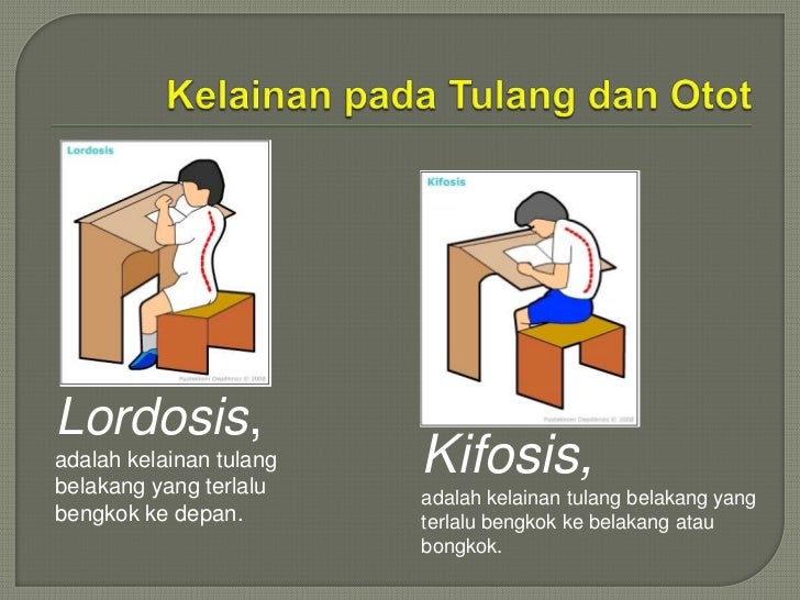 Kelainan Tulang Belakang Yang Terlalu Bengkok Ke Depan Kelainan Tulang Belakang Yang Terlalu Bengkok Ke Depan