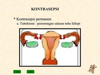 KONTRASEPSI
* Kontrasepsi permanen* Kontrasepsi permanen
a. Tubektomi : pemotongan saluran tuba fallopia. Tubektomi : pemotongan saluran tuba fallopi
 