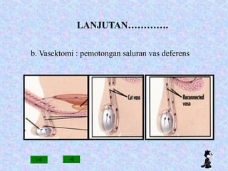 LANJUTAN………….
b. Vasektomi : pemotongan saluran vas deferens
 