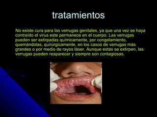 tratamientostratamientos
No existe cura para las verrugas genitales, ya que una vez se hayaNo existe cura para las verrugas genitales, ya que una vez se haya
contraído el virus este permanece en el cuerpo. Las verrugascontraído el virus este permanece en el cuerpo. Las verrugas
pueden ser extirpadas químicamente, por congelamiento,pueden ser extirpadas químicamente, por congelamiento,
quemándolas, quirúrgicamente, en los casos de verrugas másquemándolas, quirúrgicamente, en los casos de verrugas más
grandes o por medio de rayos láser. Aunque estas se extirpen, lasgrandes o por medio de rayos láser. Aunque estas se extirpen, las
verrugas pueden reaparecer y siempre son contagiosas.verrugas pueden reaparecer y siempre son contagiosas.
 