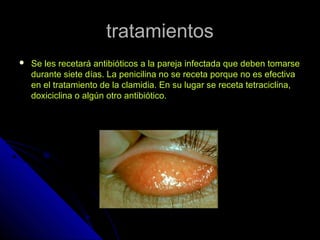 tratamientostratamientos
 Se les recetará antibióticos a la pareja infectada que deben tomarseSe les recetará antibióticos a la pareja infectada que deben tomarse
durante siete días. La penicilina no se receta porque no es efectivadurante siete días. La penicilina no se receta porque no es efectiva
en el tratamiento de la clamidia. En su lugar se receta tetraciclina,en el tratamiento de la clamidia. En su lugar se receta tetraciclina,
doxiciclina o algún otro antibiótico.doxiciclina o algún otro antibiótico.
 