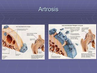 Artrosis
 