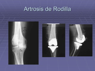 Artrosis de Rodilla
 