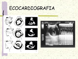 ECOCARDIOGRAFIA 