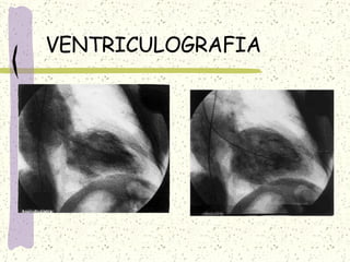 VENTRICULOGRAFIA 