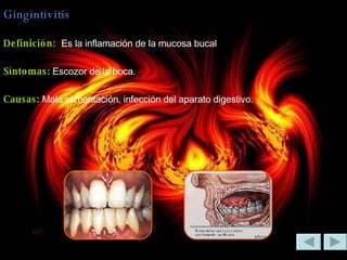 Gingintivitis Definición:  Es la inflamación de la mucosa bucal Síntomas:  Escozor de la boca. Causas:  Mala alimentación, infección del aparato digestivo. 