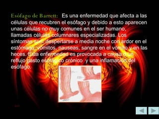 Esófago de Barrett:   Es una enfermedad que afecta a las células que recubren el esófago y debido a esto aparecen unas células no muy comunes en el ser humano, llamadas células columnares especializadas. Los síntomas son: despertarse a media noche con ardor en el estómago, vómitos, nauseas, sangre en el vómito y en las heces. Esta enfermedad es provocada a causa d un reflujo gasto esofágico crónico  y una inflamación del esófago.  