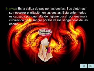 Piorrea:   Es la salida de pus por las encías. Sus síntomas son escozor e irritación en las encías. Esta enfermedad es causada por una falta de higiene bucal  por una mala circulación de la sangre por los vasos sanguíneos de las encías. 