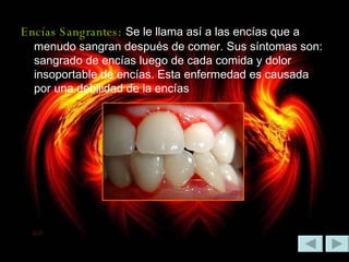 Encías Sangrantes:   Se le llama así a las encías que a menudo sangran después de comer. Sus síntomas son: sangrado de encías luego de cada comida y dolor insoportable de encías. Esta enfermedad es causada por una debilidad de la encías 