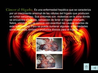 Cáncer al Hígado:   Es una enfermedad hepática que se caracteriza por un crecimiento anormal de las células del hígado que producen un tumor canceroso. Sus síntomas son: molestias en la zona donde se encuentra el hígado, sensación de tener el hígado hinchado, fiebre, vómitos. No se conoce con exactitud las causas exactas de esta enfermedad. Pero se puede numerar algunas: enfermedades como hepatitis, cirrosis y productos tóxicos para el hígado. 