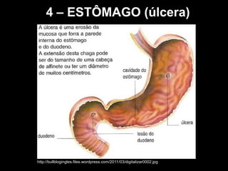 4 – ESTÔMAGO (úlcera)
http://bullblogingles.files.wordpress.com/2011/03/digitalizar0002.jpg
 