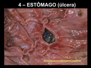 4 – ESTÔMAGO (úlcera)
 