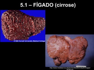 5.1 – FÍGADO (cirrose)
http://www.meddean.luc.edu/lumen/MedED/orfpath/images/
 