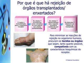 O Sistema Imunitário
Por que é que há rejeição de
órgãos transplantados/
enxertados?
Para minimizar as reacções de
rejeição no organismo humano,
procuram-se tecidos ou órgãos
que sejam, tanto quanto possível,
compatíveis com as
características bioquímicas do
receptor.
 