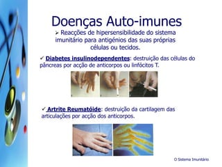 O Sistema Imunitário
Doenças Auto-imunes
 Reacções de hipersensibilidade do sistema
imunitário para antigénios das suas próprias
células ou tecidos.
 Diabetes insulinodependentes: destruição das células do
pâncreas por acção de anticorpos ou linfócitos T.
 Artrite Reumatóide: destruição da cartilagem das
articulações por acção dos anticorpos.
 