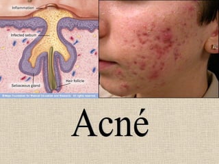 Acné 