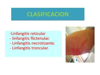 Linfangitis Reticular Sistema linfatico | PPTX