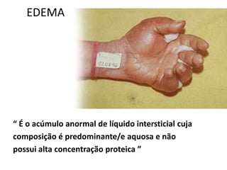 EDEMA
“ É o acúmulo anormal de líquido intersticial cuja
composição é predominante/e aquosa e não
possui alta concentração proteica ”
 