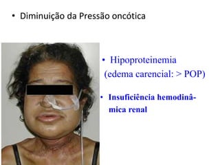 • Diminuição da Pressão oncótica
• Hipoproteinemia
(edema carencial: > POP)
• Insuficiência hemodinâ-
mica renal
 