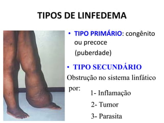 TIPOS DE LINFEDEMA
• TIPO PRIMÁRIO: congênito
ou precoce
(puberdade)
• TIPO SECUNDÁRIO
Obstrução no sistema linfático
por:
2- Tumor
1- Inflamação
3- Parasita
 