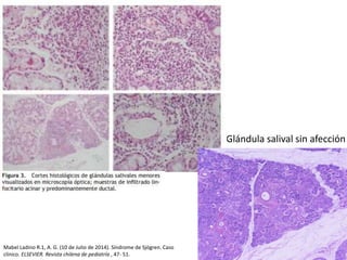 Glándula salival sin afección
Mabel Ladino R.1, A. G. (10 de Julio de 2014). Síndrome de Sjögren. Caso
clínico. ELSEVIER. Revista chilena de pediatría , 47- 51.
 