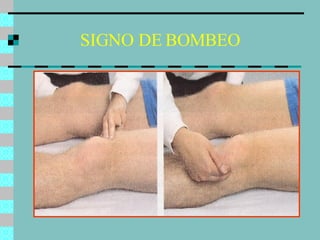 SIGNO DE BOMBEO 