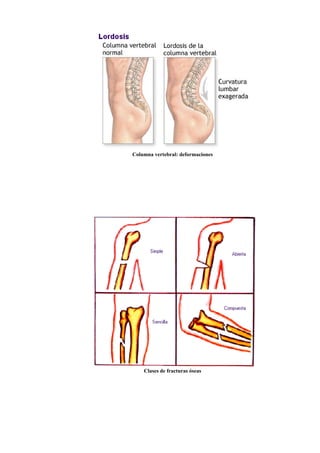Columna vertebral: deformaciones
Clases de fracturas óseas
 