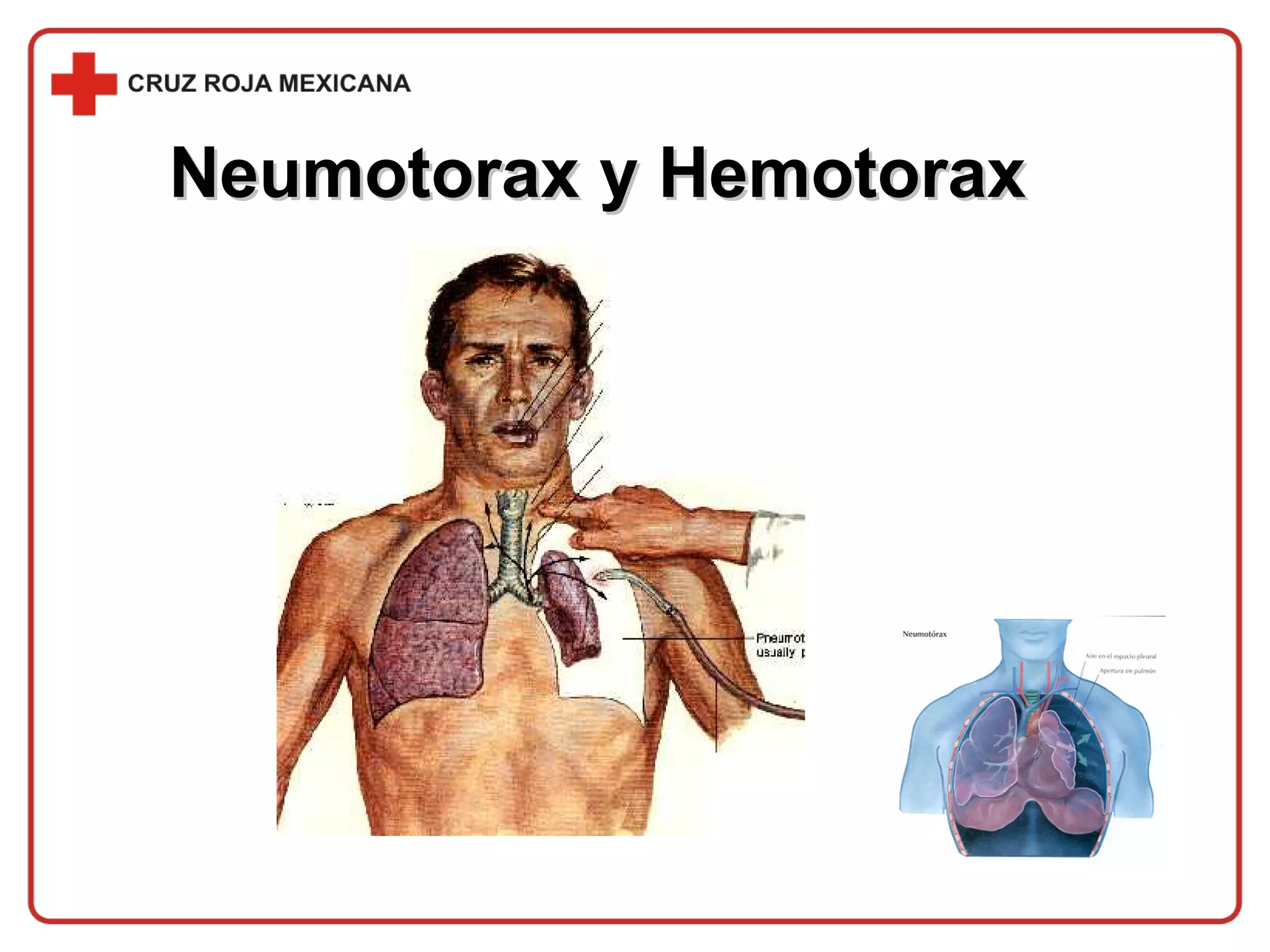 Neumotorax y Hemotorax 